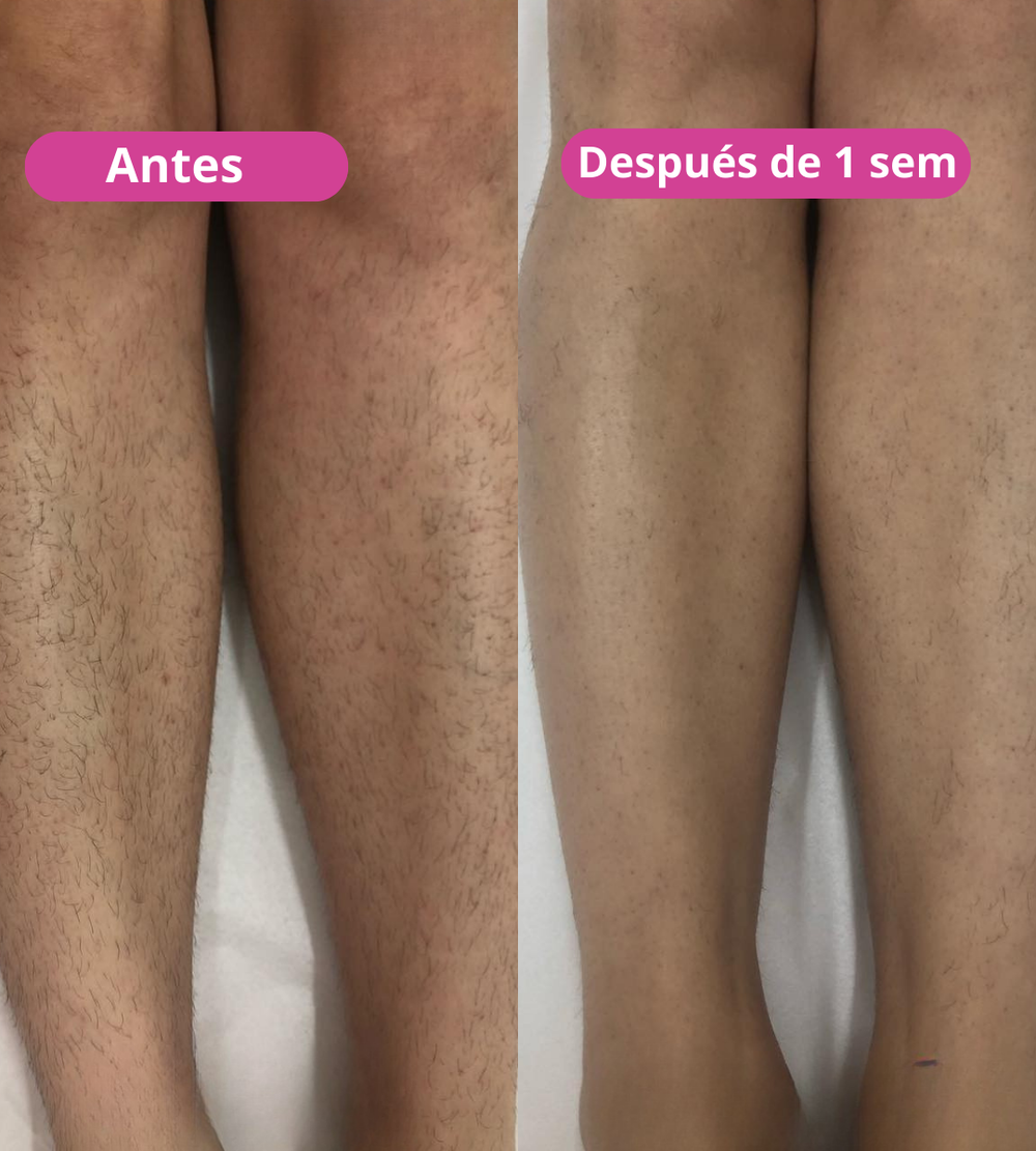 <p><strong>Amado por quienes eligieron una forma natural de reducir el vello. No te quedes fuera.</strong></p>