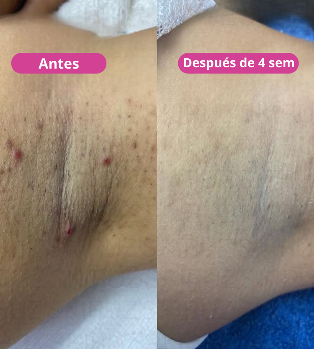 <p><strong>Amado por quienes eligieron una forma natural de reducir el vello. No te quedes fuera.</strong></p>